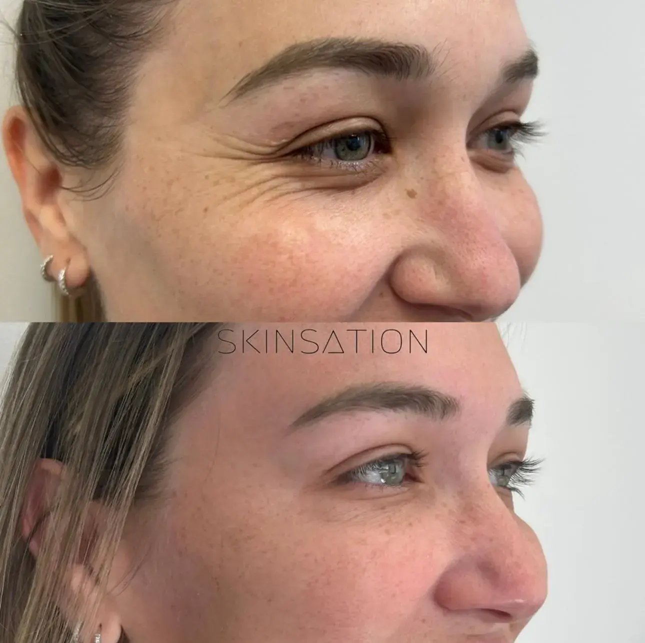 Cosmetic Enhancement with Botox