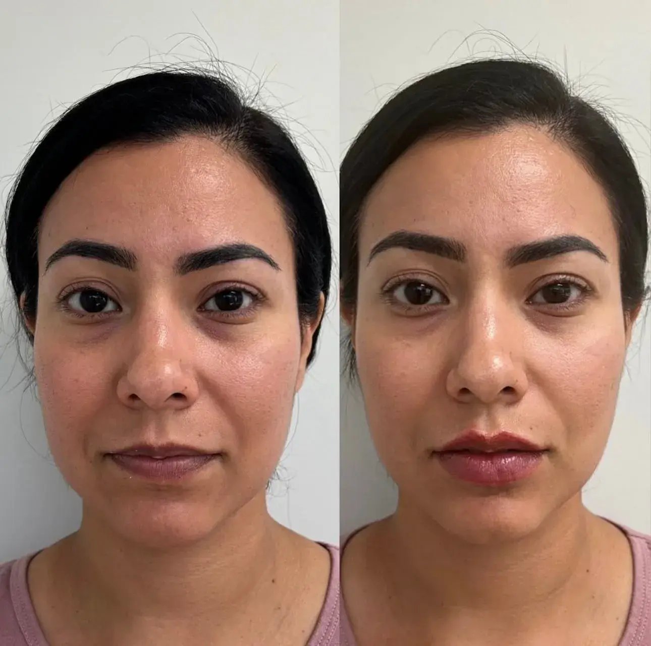 Juvederm