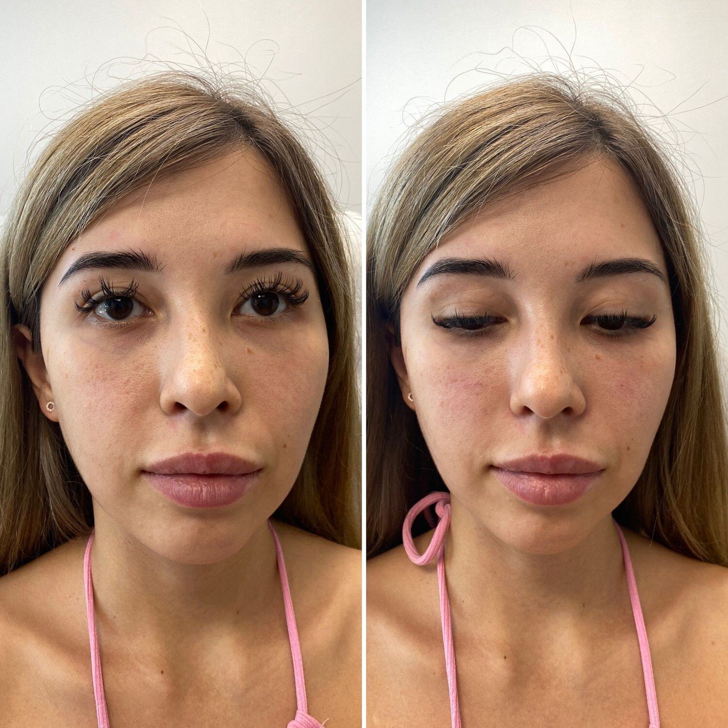 Treatment Before & After