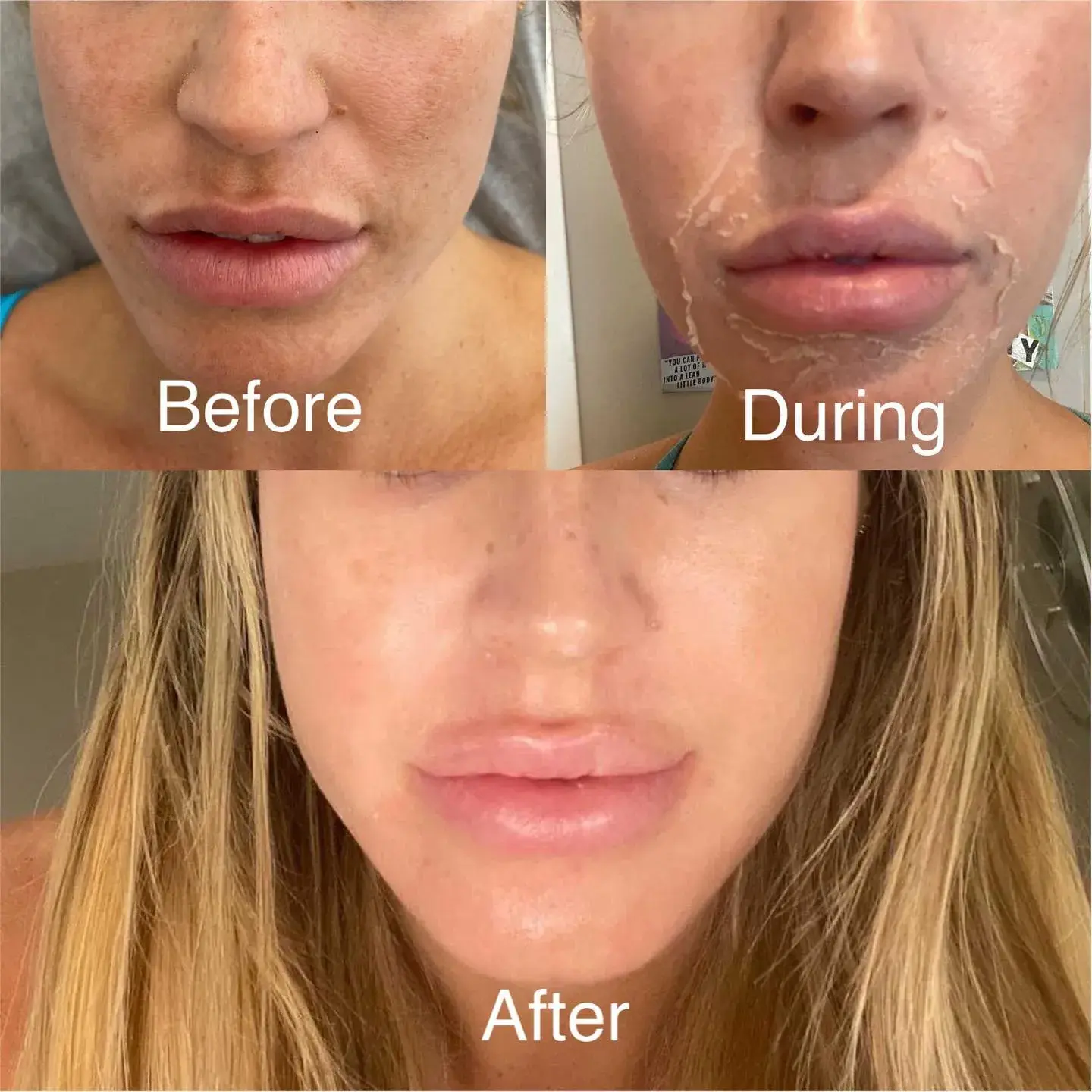 Chemical-peel-by-skinsation-la