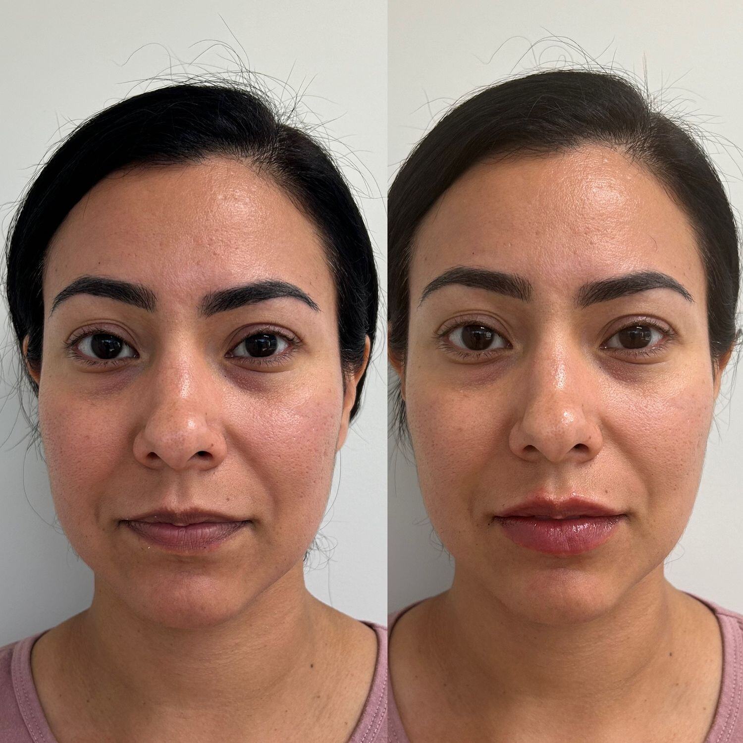 Lip Filler Before & After