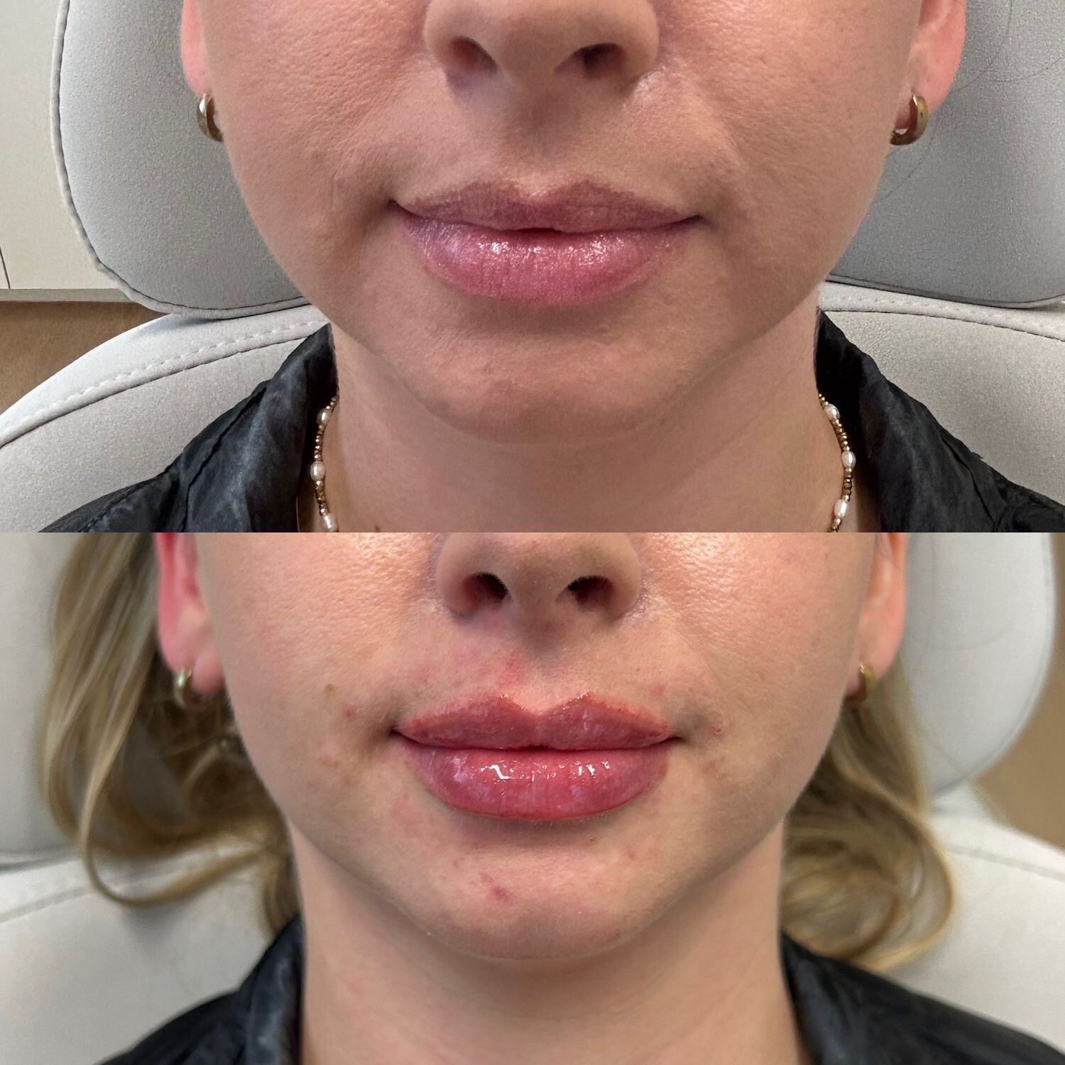 Lip Filler Before & After