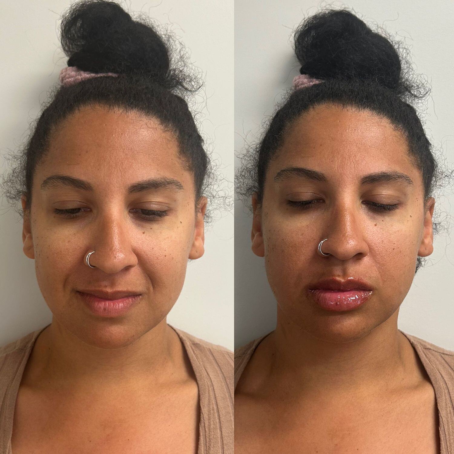 Lip Filler Before & After