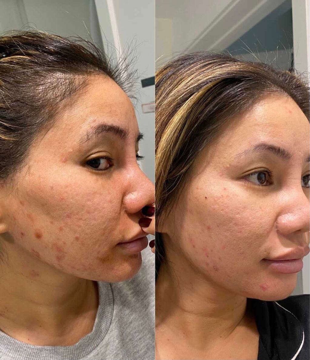 Acne & Acne Scaring Before & After