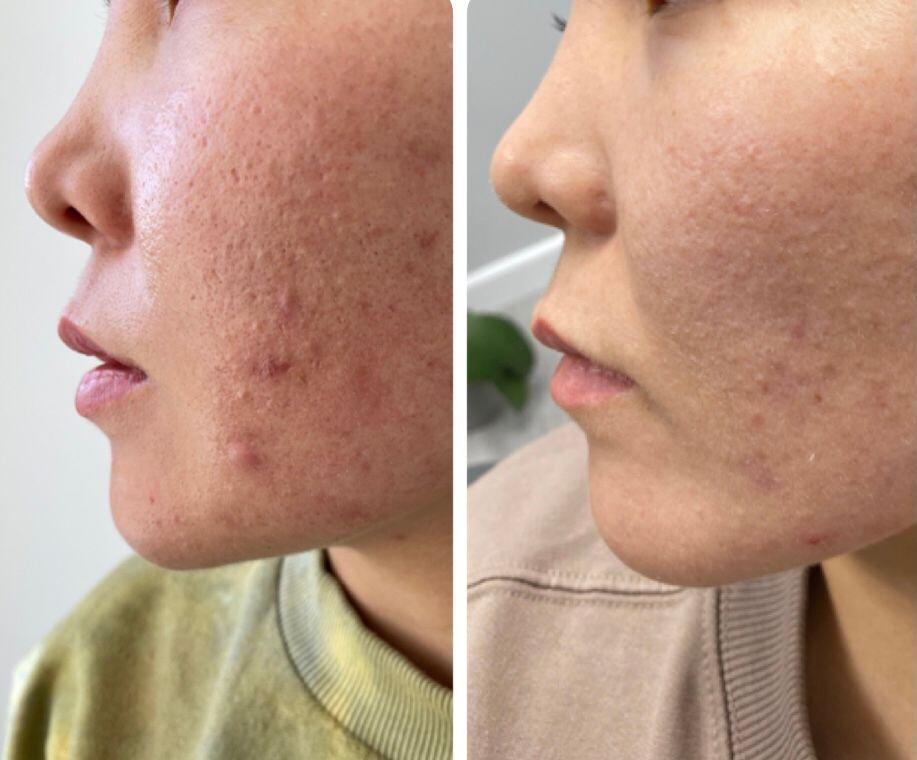 Acne & Acne Scaring Before & After