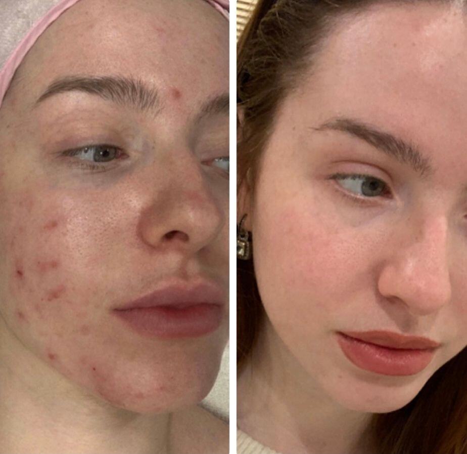 Acne & Acne Scaring Before & After