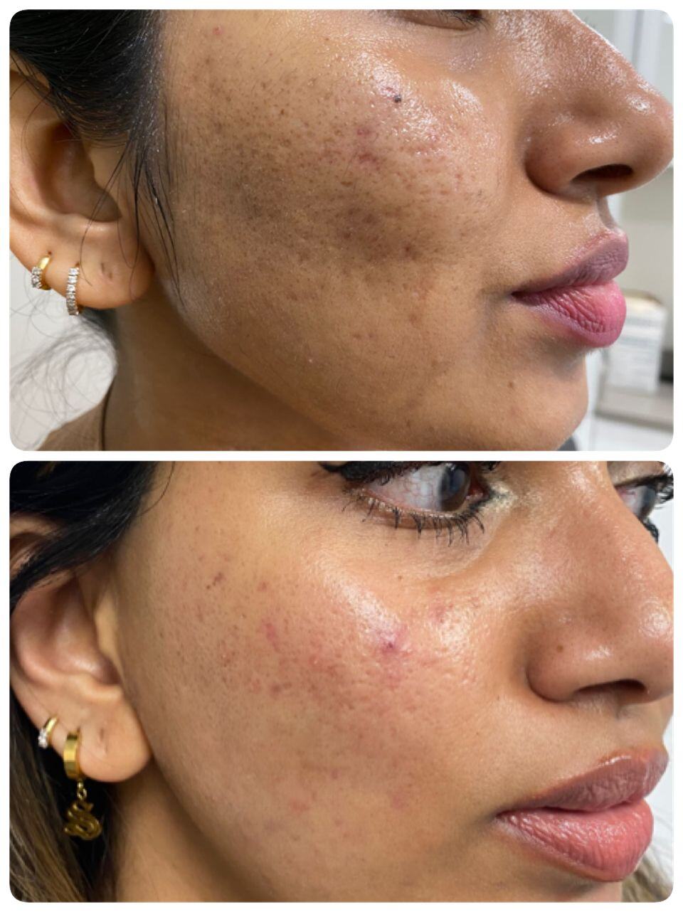 Acne & Acne Scaring Before & After