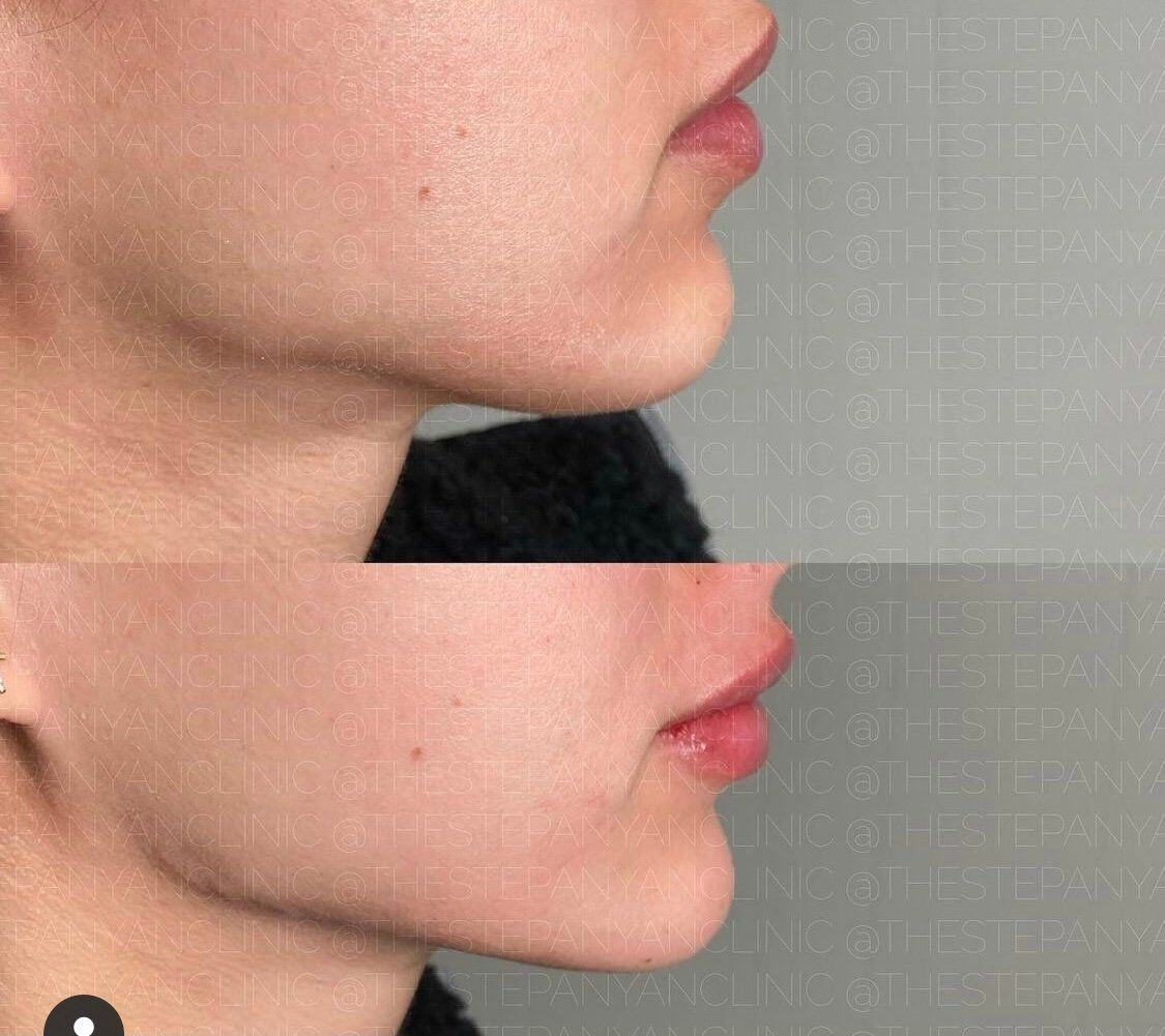 Treatment Before & After