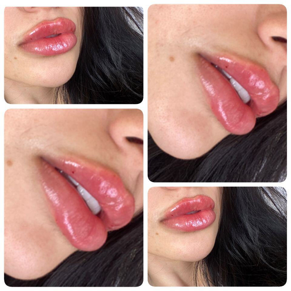 Lip Filler Before & After