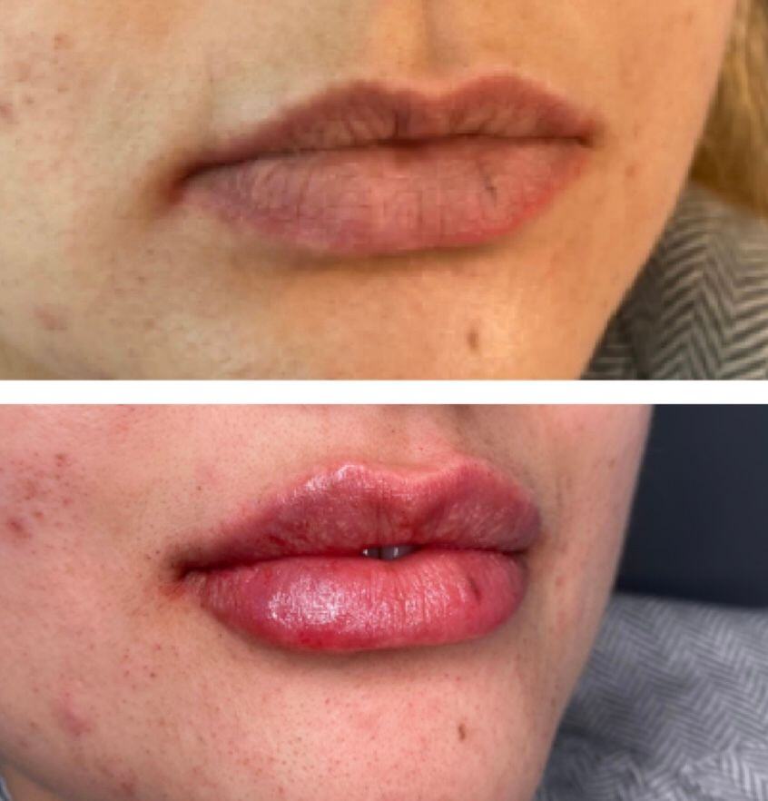 Lip Filler Before & After