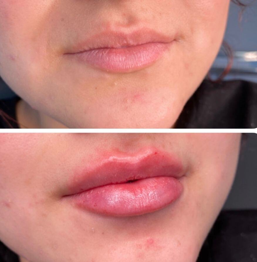 Lip Filler Before & After