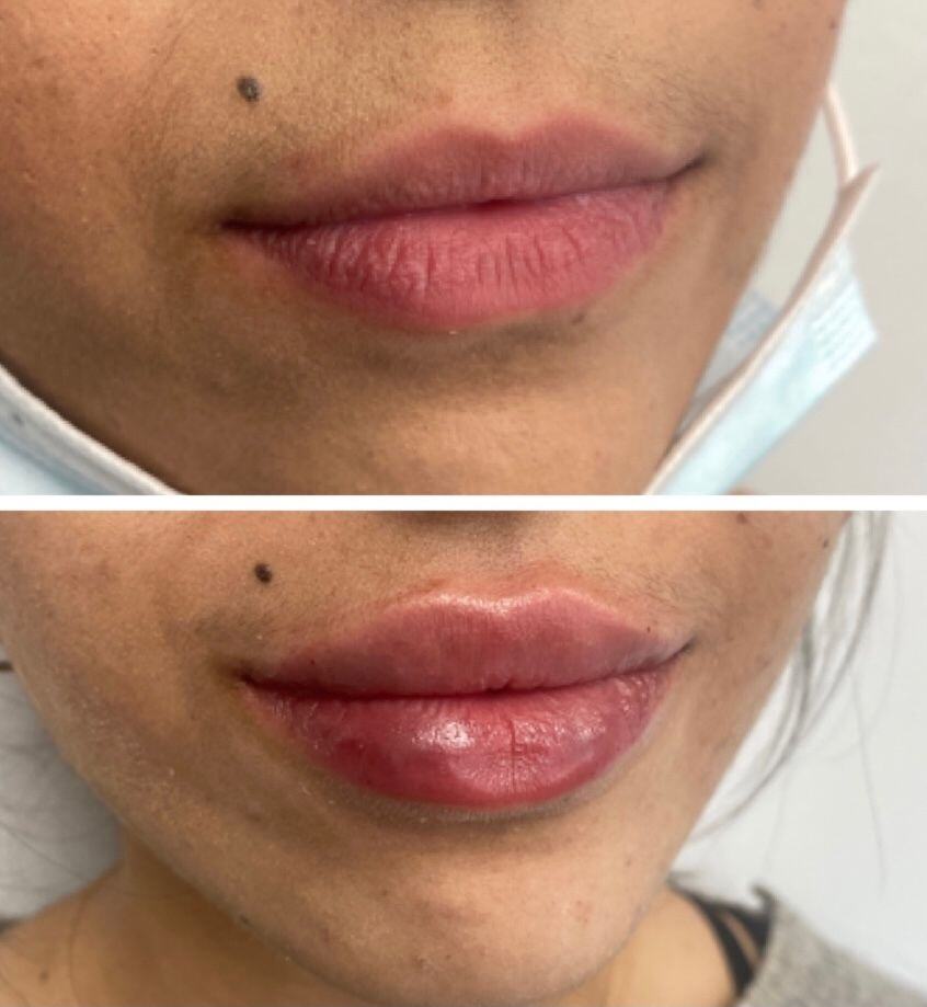 Lip Filler Before & After