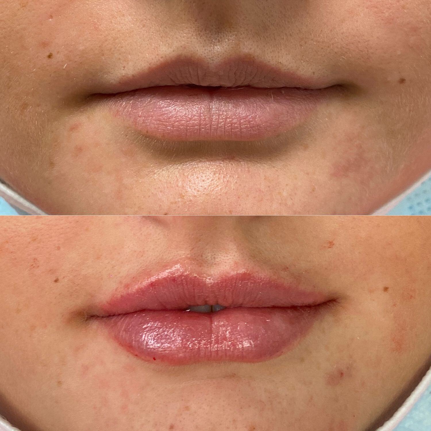 Lip Filler Before & After