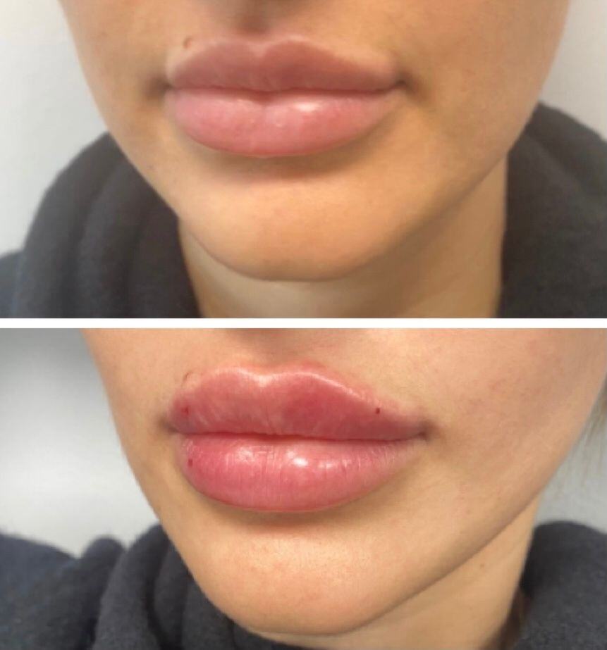 Lip Filler Before & After