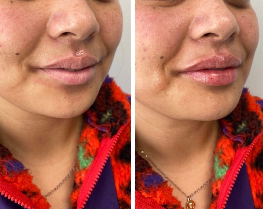 Lip Filler Before & After