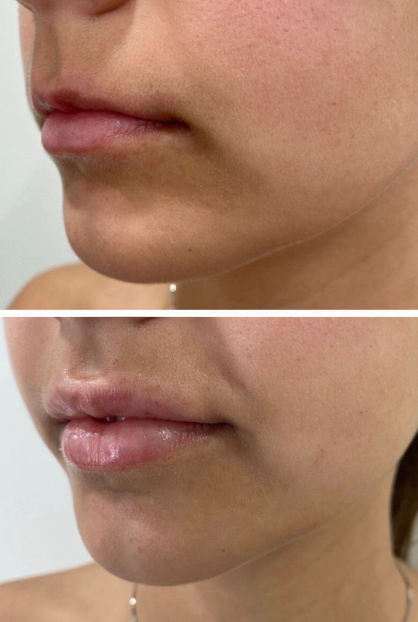 Lip Filler Before & After