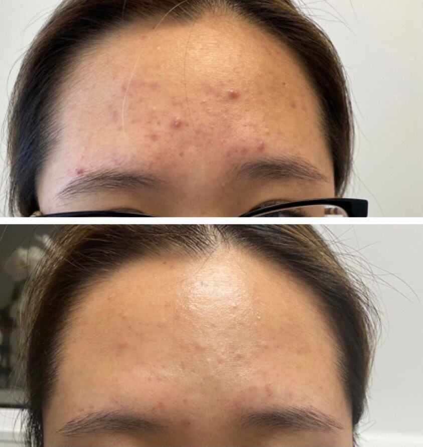 Acne & Acne Scaring Before & After