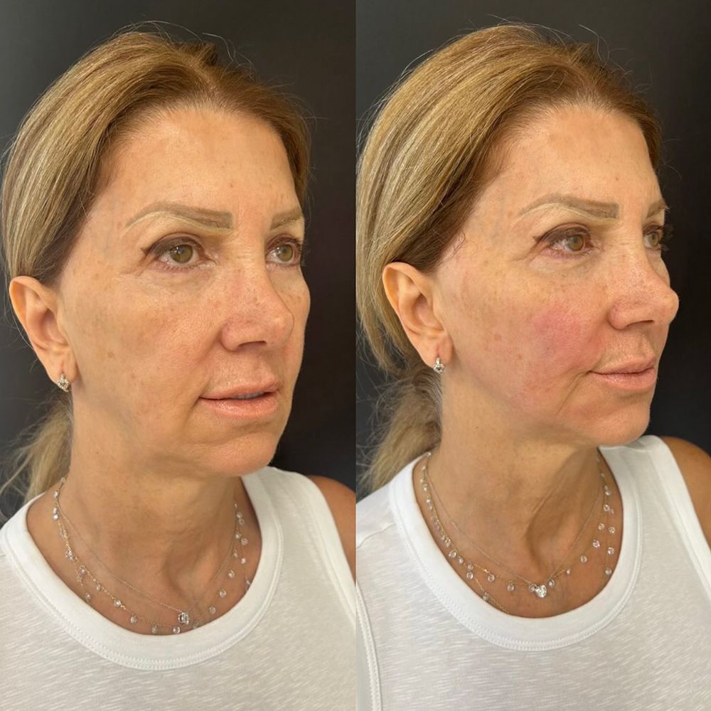 Newport Beach Restylane patient before and after