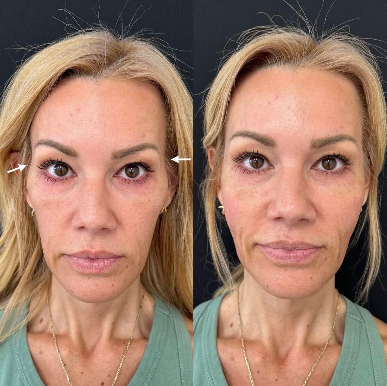 Newport Beach Sculptra model with blonde hair