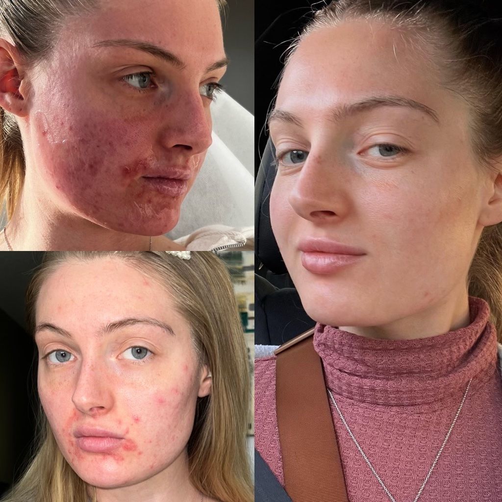 Newport Beach Acne Treatment patient before and after